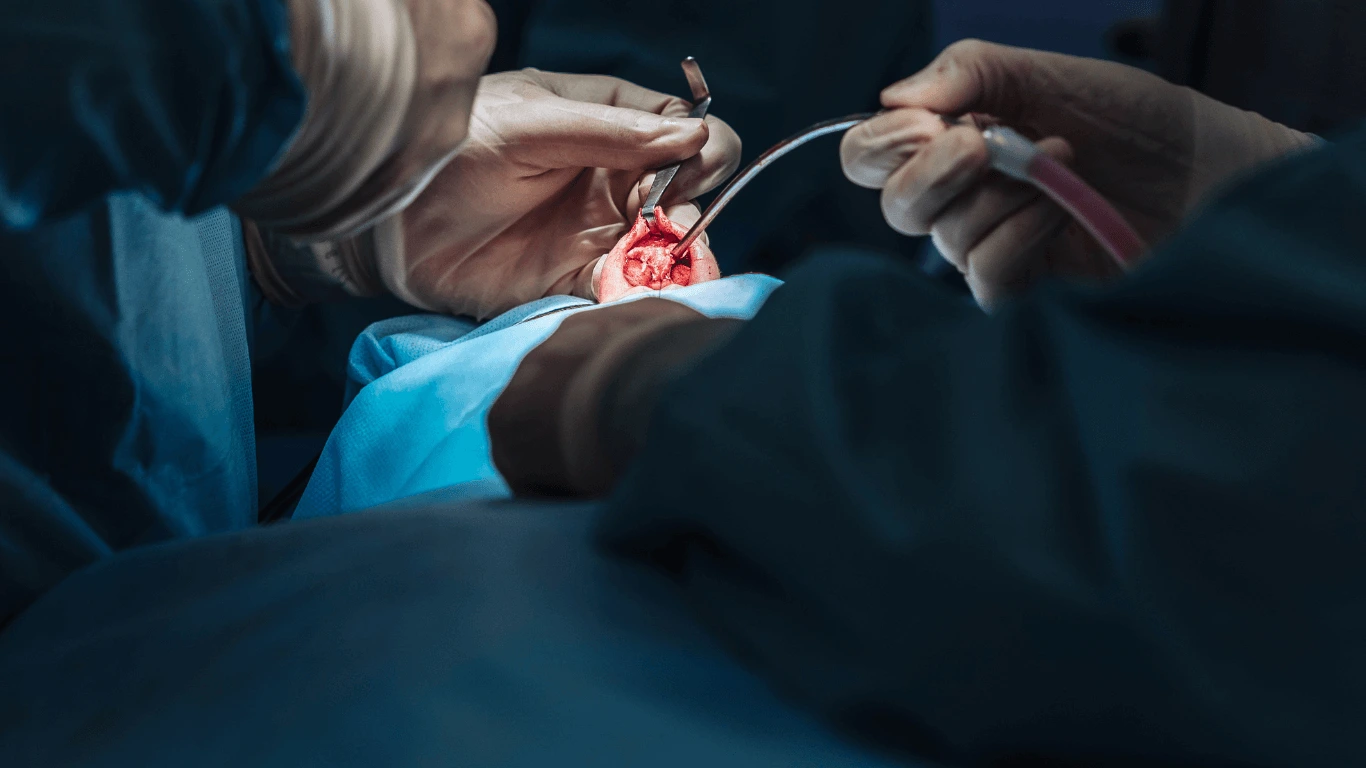 Elite Cirugía Plástica: Precio de Rinoplastia en Perú